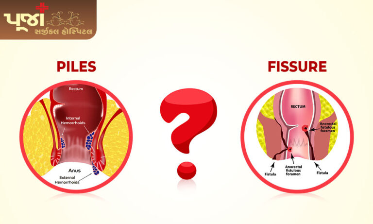 What is the difference between Piles and Fissure?