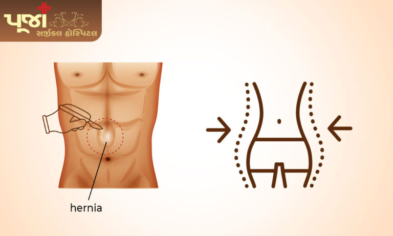 How to reduce weight after hernia surgery
